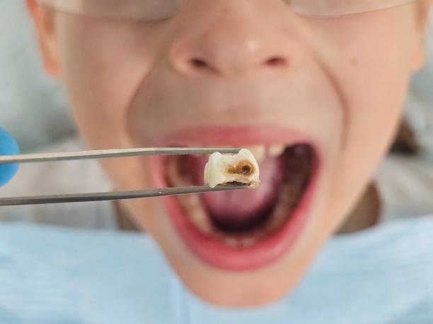 Best Root Canal Emergency Dentist  in Pelican Bay, TX